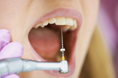 Удаление зубного нерва - нюансы процедуры